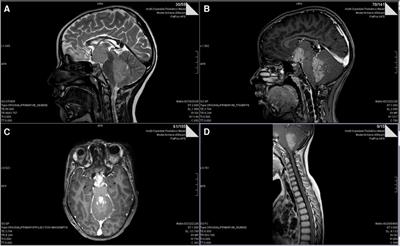 Unforeseen cytomegalovirus retinopathy following high dose thiotepa and proton irradiation in a pediatric patient with high-risk medulloblastoma: A case report